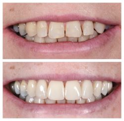Veneers For Gap Teeth