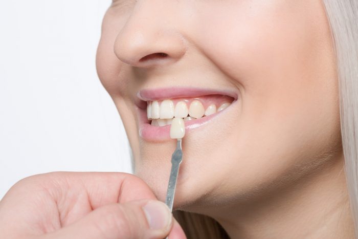 Veneers For Stained Teeth