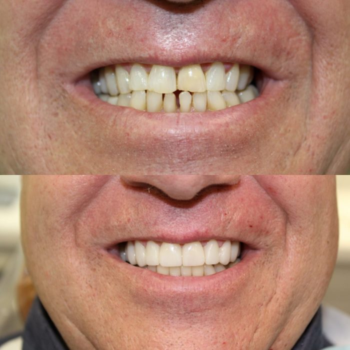 Porcelain Veneers For Teeth