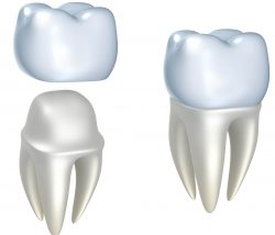 Dental Crown Replacement in Houston, TX | Dental crown & Bridge