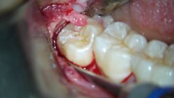 Wisdom Tooth Extraction Near Me in Houston | Wisdom Tooth Extraction Near Me – Dentist in Housto ...