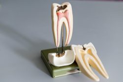 Root Canal Near Me in Houston, TX | Cost of Root Canal in Houston, Tx | West U Dentist