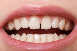 Teeth Bonding Near Me in Houston | Cosmetic Teeth Bonding In Houston, TX – Pearl Shine Dental