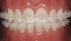 Type of Braces : Which is Better: Metal Braces or Ceramic Braces |