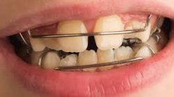 Orthodontics Specialist Of Florida |Emergency Orthodontist – Best Orthodontist Treatment FL