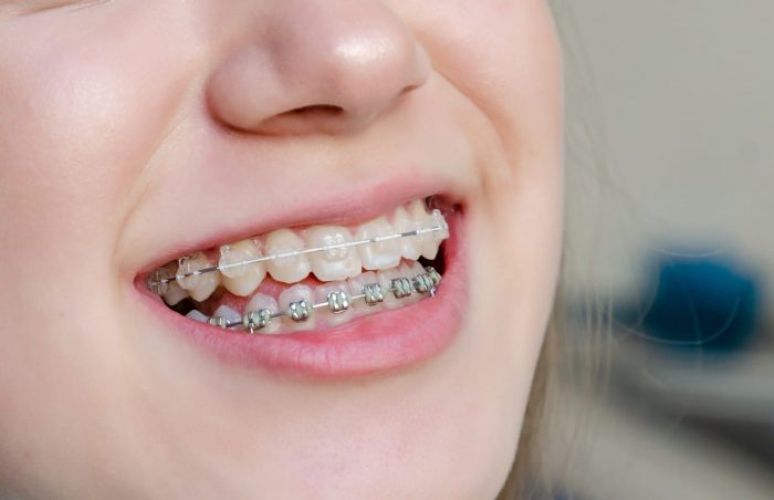 Best Dentist for Braces Near Me – Find Orthodontist in Miami