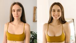 Breast Augmentation Before After | Before And After Breast Augmentation
