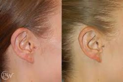 Ear Surgery Otoplasty Houston, Texas | Premiere Surgical Arts