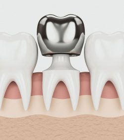 Affordable Dental Implants – Dental Implants You Can Trust