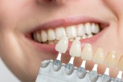 veneers for front teeth gap
