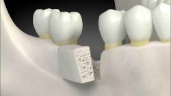 Dental Implant Options Near Me |Painless Dental Implants