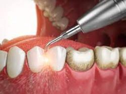 Periodontal Gum Disease – Houston TX