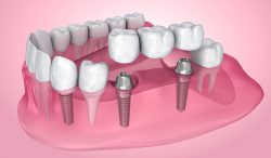The Importance of Dental Implant Esthetics