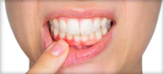 Periodontitis: Symptoms, Causes, and Treatments |Gingivitis Vs Periodontitis