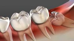When is emergency tooth extraction needed? Tooth Extractions: What You Need To Know
