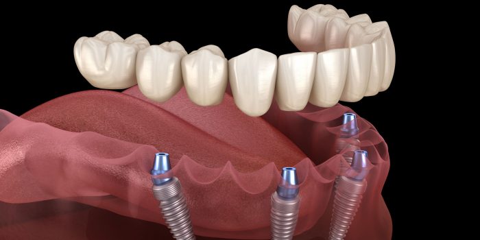 What are full mouth dental implants and what do they cost?