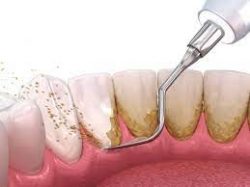 Gum Disease Treatment Houston Tx |Periodontal Gum Disease Treatment Houston TX