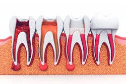 Root Canal: What Is It, Diagnosis, Treatment, Side Effects|What is root canal therapy?