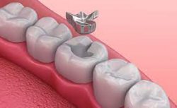 Dental Amalgam Fillings -What Are Amalgam Or Silver Fillings?