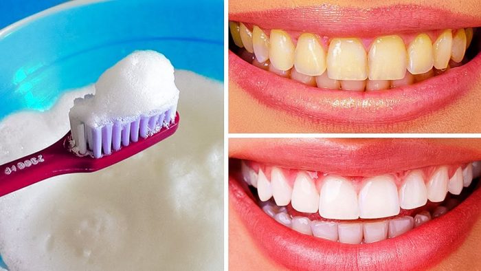 Which Home Remedy Is Best For Teeth Whitening? |Want Whiter Teeth?