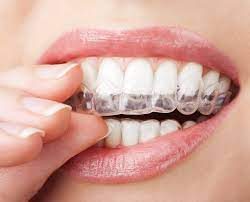 Advantages of Invisalign for Teens | What Are The Advantages Of Invisalign Teen?