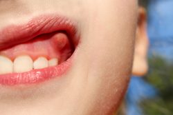 What Causes Swollen Gums? | How To Get Rid Of Swollen Gums? | Gum Problem Basics: Sore, Swollen, ...