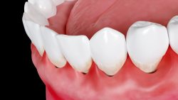 What Causes Swollen Gums? | Gums – swollen Information | Mount Sinai – New York