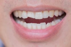 Porcelain veneers for Cracked Tooth