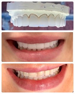Dental Veneers Specialist In Houston | Porcelain Veneers Houston | Cosmetic Dentist | Terri Alan ...