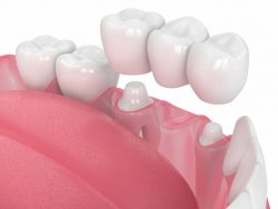 What are Dental Crowns and Tooth Bridges? | Dental Bridges: Who Needs Them, Types, Costs, Procedure