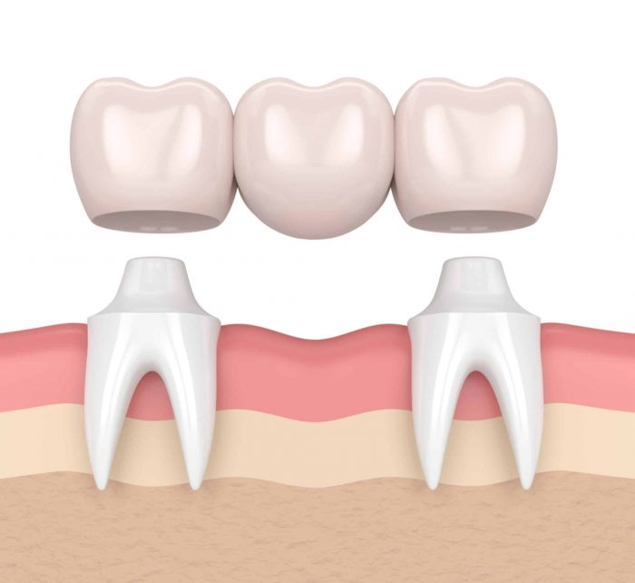 Dental Tooth Supported Bridge | Combined Implant and Tooth Support: An Up-to-Date … – ...