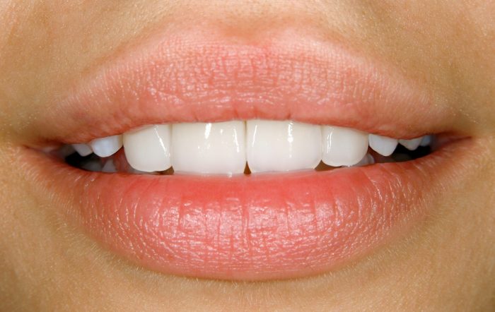 Dental Bridges in Aventura, FL | Aventura Dentist North Miami Dentist porcelain Bridges Aventura