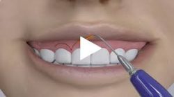 What Is A Gingivectomy Procedure? | GINGIVECTOMY – PROCEDURE EXPLAINED IN 5 MINUTES