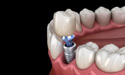 Affordable Dentures And Implants Near Me