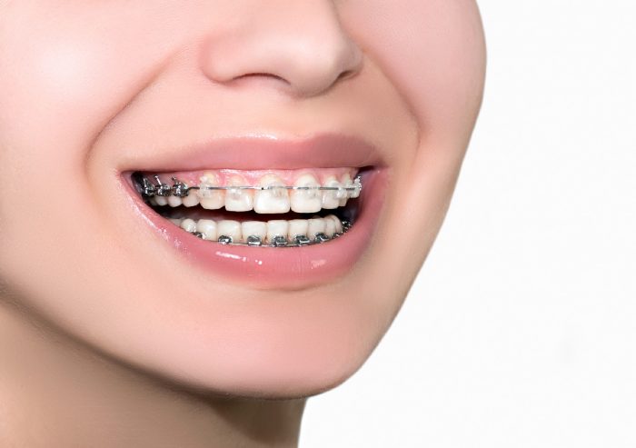 Braces Treatment : How Much Do Clear Braces Cost?