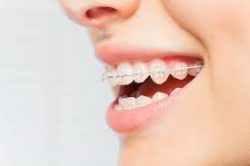 Adult braces before and after |Adult Braces Before And After: Which Orthodontics Are For You?