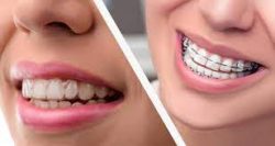 Braces for teeth straightening – teeth before and after braces