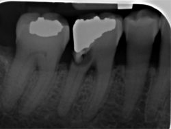 Periapical X-Ray | Bitewing X-rays | Digital Dental X-Rays Houston, TX