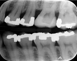Periapical X-Ray | Bitewing X-rays | Digital Dental X-Rays Houston, TX |Cost of Dental X-Rays