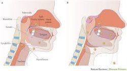 Central Sleep Apnea Treatment | Obstructive Sleep Apnea Causes