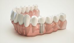 Affordable Dentures And Implants Near Me | dental implant treatment at low cost