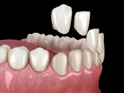 Dental Veneers For Crooked Teeth | Find the Answer To: Can Veneers Fix Crooked Teeth?