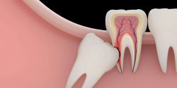 Wisdom Tooth Removal Houston TX | Affordable Wisdom Teeth Removal Houston