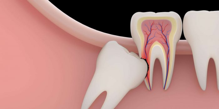 Wisdom Tooth Removal Houston TX | Affordable Wisdom Teeth Removal Houston