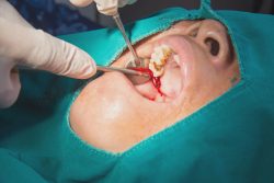  Emergency Wisdom Tooth Removal | Oral Surgery