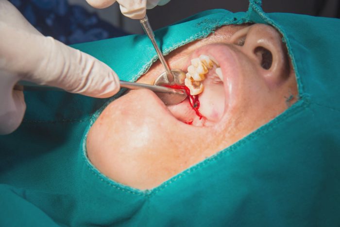  Emergency Wisdom Tooth Removal | Oral Surgery