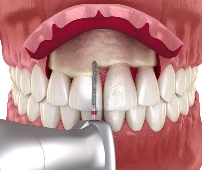 Cost of Crown Lengthening | How Much Does Crown Lengthening