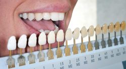 Teeth Whitening Treatment in Houston | Affordable Teeth Whitening