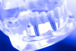 Affordable Dental Implants in Houston TX | Average Cost Of Dental Implants