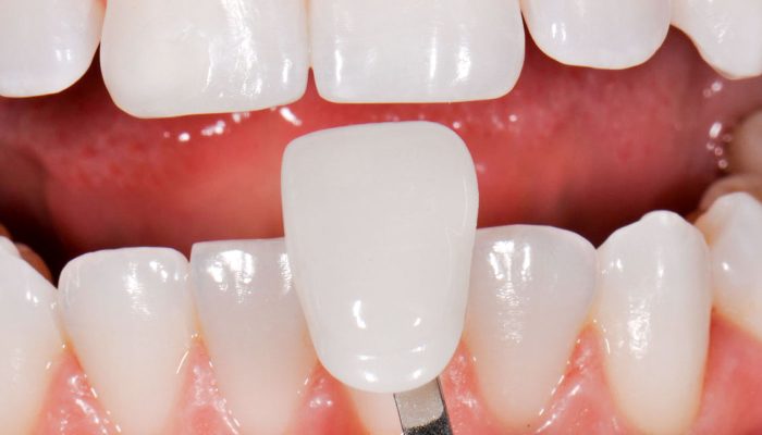 Best Porcelain Veneers For Teeth | Best Veneers